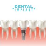 Dental implant